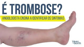 Como identificar a trombose venosa profunda [upl. by Laamaj]