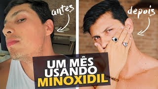 1 mês usando MINOXDIL [upl. by Hsivat]