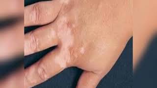 Vitiligo Hypopigmented patches through Hijamacupping therapy 7090466288 [upl. by Coe]