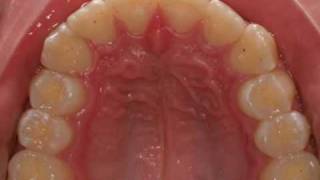 invisalign severe overjet [upl. by Pete]