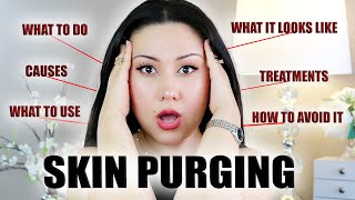 SKIN PURGING Fully Explained  Is It a Good Sign Causes Of Skin Purging amp What To Use  Zulayla [upl. by Carie361]