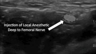 Ultrasound Guided Femoral Nerve Block [upl. by Veal910]