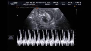 Ultrassonografia Obstétrica com medida da Translucência Nucal  12 semanas e 6 dias [upl. by Hteboj734]