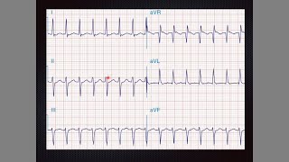 EKG patológico 2 Bradiarritmias y taquiarritmias [upl. by Trembly]