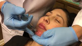 NonSurgical Chin Augmentation using Juvederm Voluma 3cc [upl. by Rehpotsirhk]