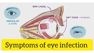 Symptoms of eye infection [upl. by Foley]