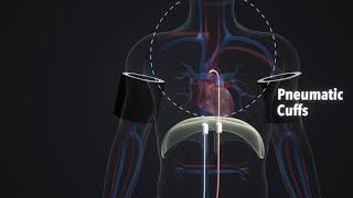 Medias Klinikum  Animation regional chemotherapy and chemofiltration for thoracic tumors [upl. by Latrell373]