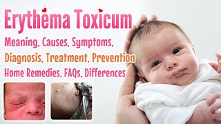 Erythema toxicum overview causes sign and symptoms treatment prevention home remedies FAQs [upl. by Fanchan467]