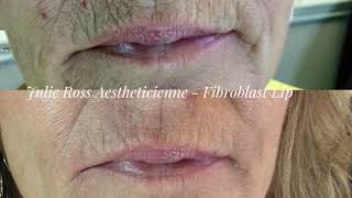 Fibroblast Lip before during after and healed [upl. by Ainod]