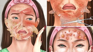 ASMR Acne scar Chemical Peel and Face Massage Full Process Treatment Animation [upl. by Wadell]