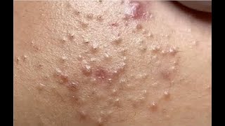 Satisfying And Relaxation with NaSa Beauty Spa 45 blackhead and acne extraction [upl. by Asirahc]