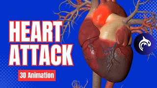 Heart Attack  Myocardial Infarction  3D Animation [upl. by Spielman623]