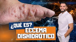 QUE ES LA DISHIDROSIS  ECZEMA DISHIDROTICO  COMO TRATAR EL ECCEMA DISHIDROTICO  DAVID CAMPOS [upl. by Ann]