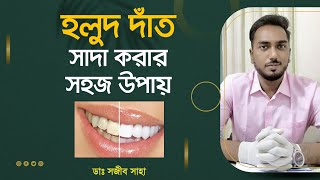 হলুদ দাঁত সাদা ঝকঝকে করার সহজ উপায়  Teeth Whitening Treatment [upl. by Merry389]