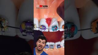 Braces Flossing Hack [upl. by Bainbrudge]