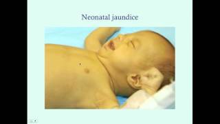 Introduction to Newborn Jaundice  CRASH Medical Review Series [upl. by Antonius751]