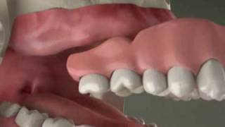 Dental Implants  Implant Overdenture in Denville NJ [upl. by Tristan]