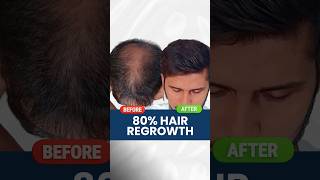 80 Hair Regrowth  Real review  Hair growth  hair fall  Hair loss Adon Hair Care viral shorts [upl. by Afrika]