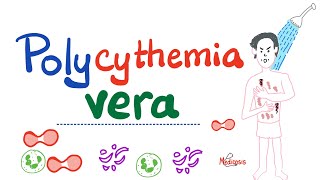 Polycythemia Vera PV  Myeloproliferative Neoplasm MPN  Erythrocytosis  Hematology [upl. by Anavlys543]