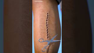 How Stitches Heal Wounds shorts science facts [upl. by Kola]