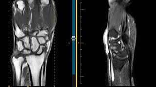 DISI and SLAC wrist scapholunate ligament tear and tenosynovitis [upl. by Raye]