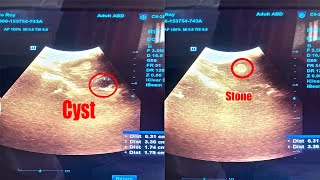 Left Renal Stone Nephrolithiasis with Left Renal Cyst ScanningDiagnosis in Ultrasonography [upl. by Kopp]