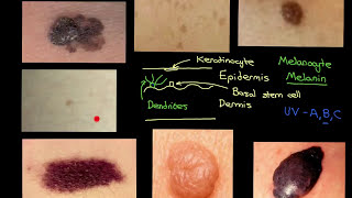 Melanocytic Lesions Part 1 [upl. by Nannah]