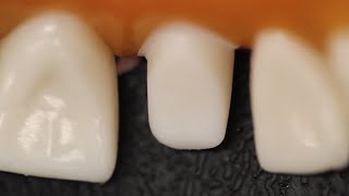 All Ceramic Crown Anterior Tooth Preparation [upl. by Ragouzis]