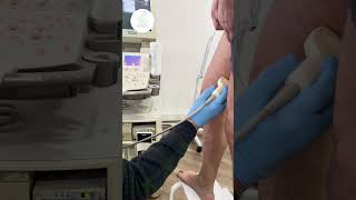 Our varicose veins laser treatment patient shares his experience with us varicoseveinstreatment [upl. by Bartolomeo]