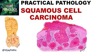 SQUAMOUS CELL CARCINOMA Clinical features amp Morphology Premalignant lesions [upl. by Froehlich]