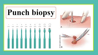 punch biopsy [upl. by Nueormahc]