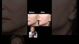 CoolPeel CO2 Laser before amp after results Remove fine lines sun damage and pore size no downtime [upl. by Ayana761]