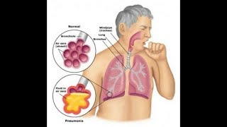 Probiotics Bifidobacterium Breve amp Lactobacillus Rhamnosus Helps Asthma  Inflammation T cell [upl. by Cox]