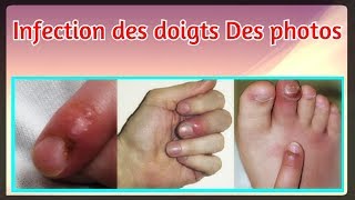 Infection des doigts Des photos [upl. by Callum]