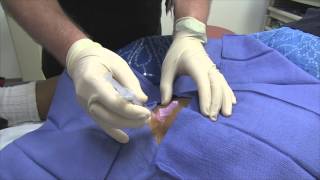 Pes Anserine Bursitis Steroid Injection [upl. by Mcmath]