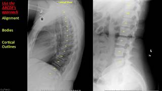 Introduction to Spine Radiographs [upl. by Josephine]