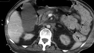 Left renal artery stenosis [upl. by Aramenta]