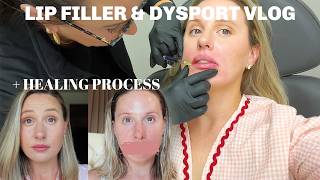 lip filler amp dysport completely painless  healing process cost amp everything you need to know [upl. by Ecylahs]