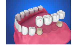 Introduction to the fixed prosthodontics [upl. by Wolsky]