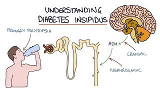 Understanding Diabetes Insipidus [upl. by Suirtimed]