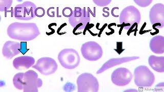 SC CrystalsCells in Hemoglobin SC Disease combo of Sickle Cell Anemia Hemoglobin S amp Hemoglobin C [upl. by Ahscrop]