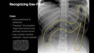 How to Read an Abdominal X Ray  Gas Pattern  Bowel Obstruction  Sentinel Loop  Toxic Megacolon [upl. by Eelram856]