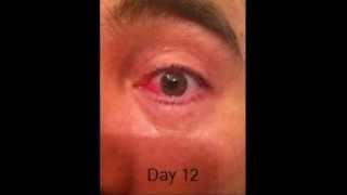 Pterygium Surgery and Recovery Daily Journal Pictures [upl. by Hoo]