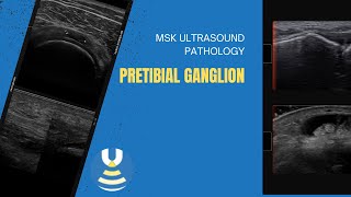 Pretibial ganglion demonstrated on ultrasound [upl. by Einneg]