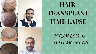 Hair transplant  time lapse Day 0 to 6 months [upl. by Gnivre]