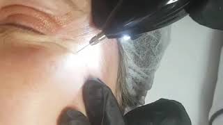 Phiion eyelid lifting treatment [upl. by Jehias729]