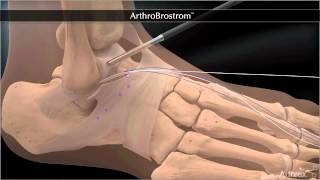 Bandrekonstruktion bei chronischer Instabilität des Sprunggelenkes  Arthroscopic Broström [upl. by Fiedler]