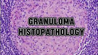 GRANULOMA  HISTOPATHOLOGY AND MORPHOLOGY [upl. by Asaph]