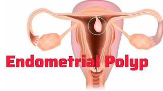 Endometrial Polyp case study [upl. by Venice160]