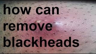 How to remove blackheads [upl. by Nilok772]